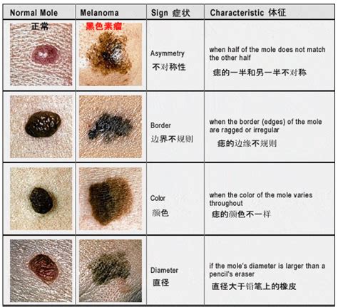 大黑痣|点痣不正规可能引发癌变：关于痣的 4 个常识